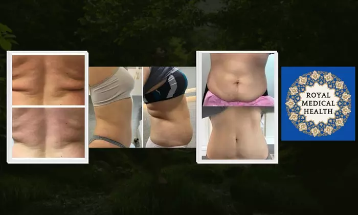 One Kybella Treatment on One Small or Large Area