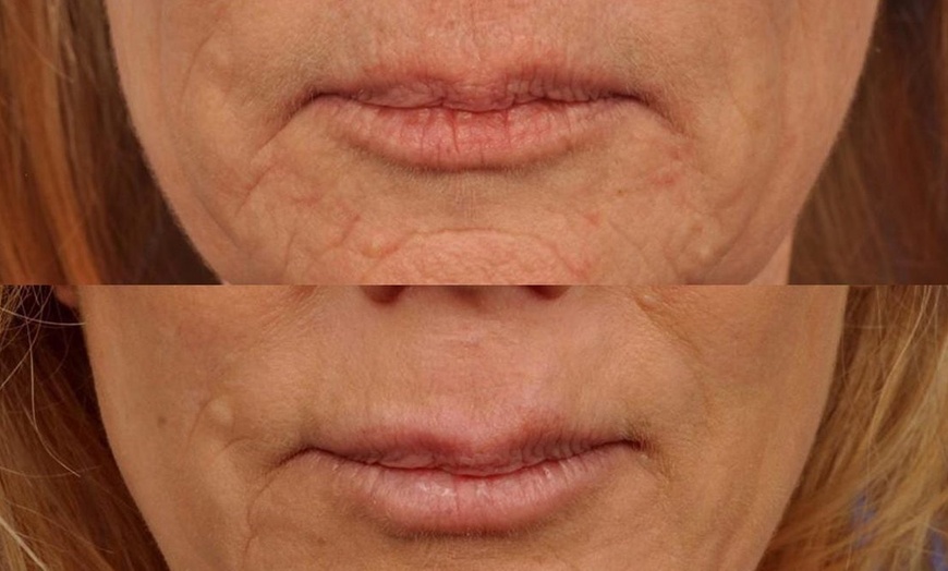 Image 3: Up to 45% Off on Facial - Diamond Peeling at AMPM AESTHETICS