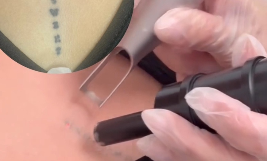 Image 3: Up to 30% Off on Tattoo Removal at My Laser and Beauty
