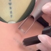 Image 3: Up to 37% Off on Tattoo Removal at My Laser and Beauty