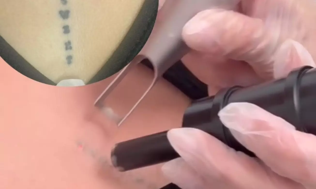 Up to 37% Off on Tattoo Removal at My Laser and Beauty