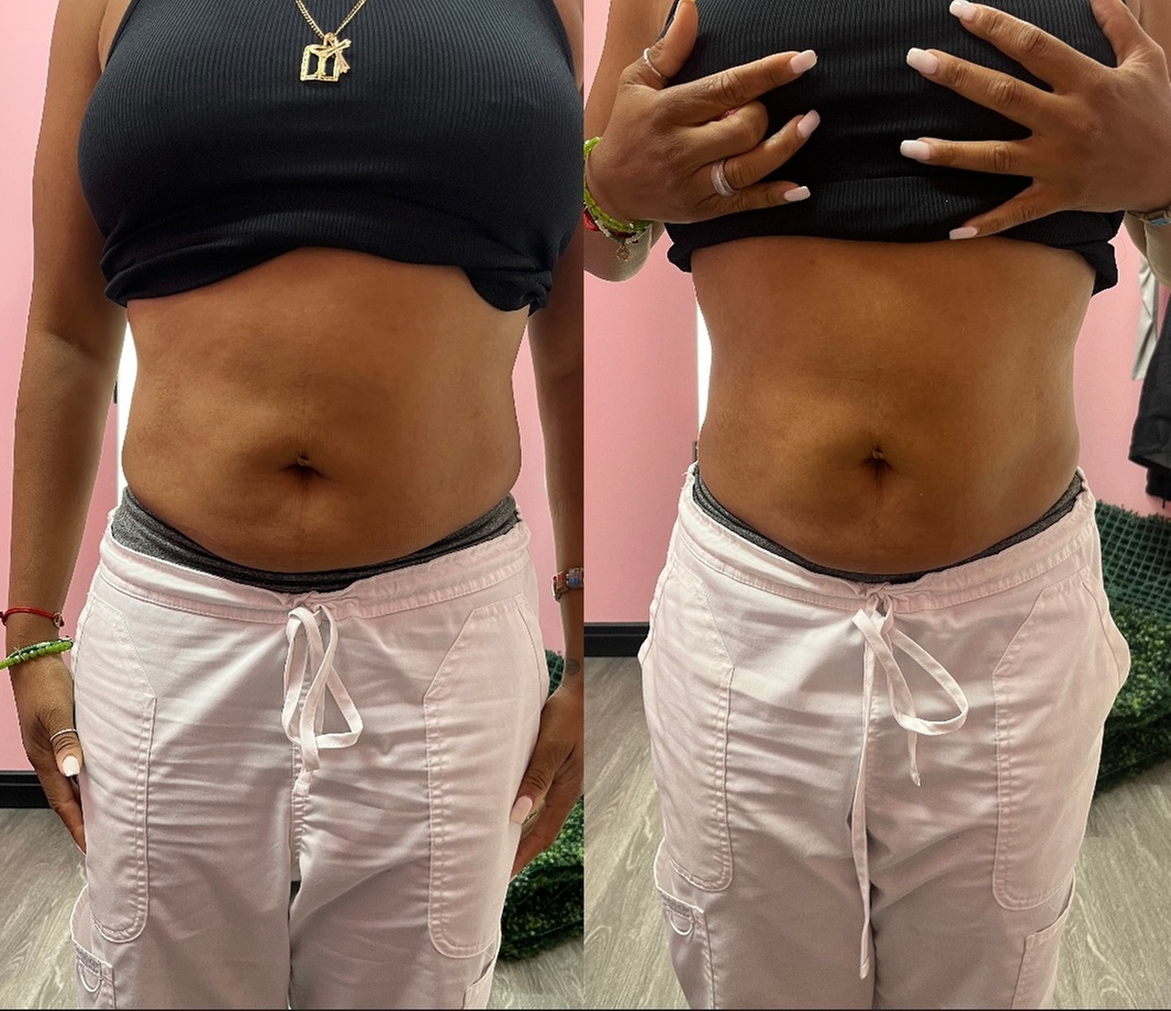 Quick Laser Lipo for Body Contouring in Just 30 or 60 Minutes