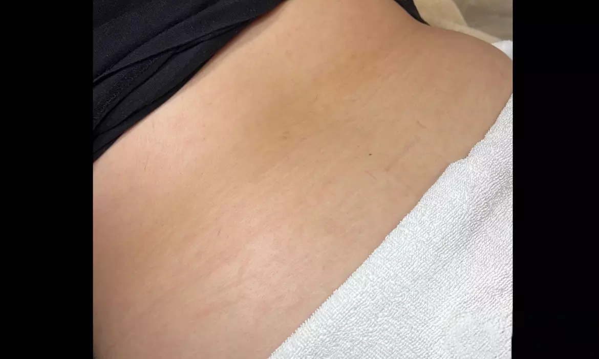 Get Smooth Skin with One or Three Stretch Mark Removal Sessions: 2x2, 4x4, 8x8, or 10x10 (Up to 36%Off) - Second Medium