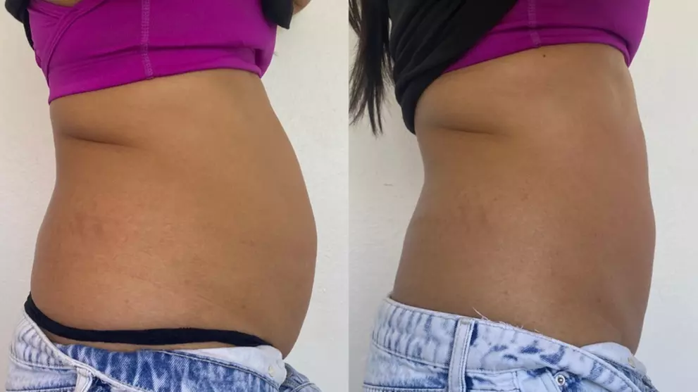 Up to 40% Off on Cavitation at Cultura Aesthetics