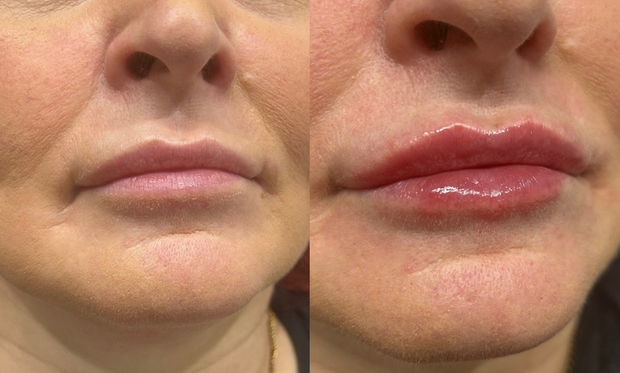 Image 6: Up to 25% Off on Facial - Anti-Ageing at Tranquil Aesthetics