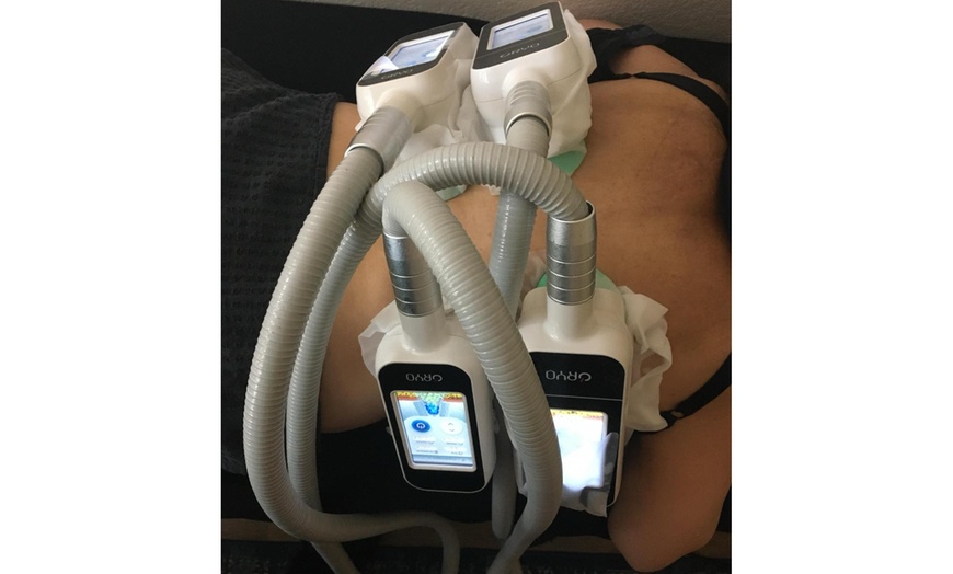 Image 4: Up to 82% Off on Fat Reduction - Non-Branded at L.A. Fat Freeze