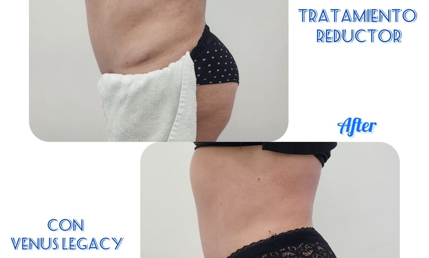 Image 3: One, Four, or Six Venus Legacy Radio Frequency Treatment on One Area
