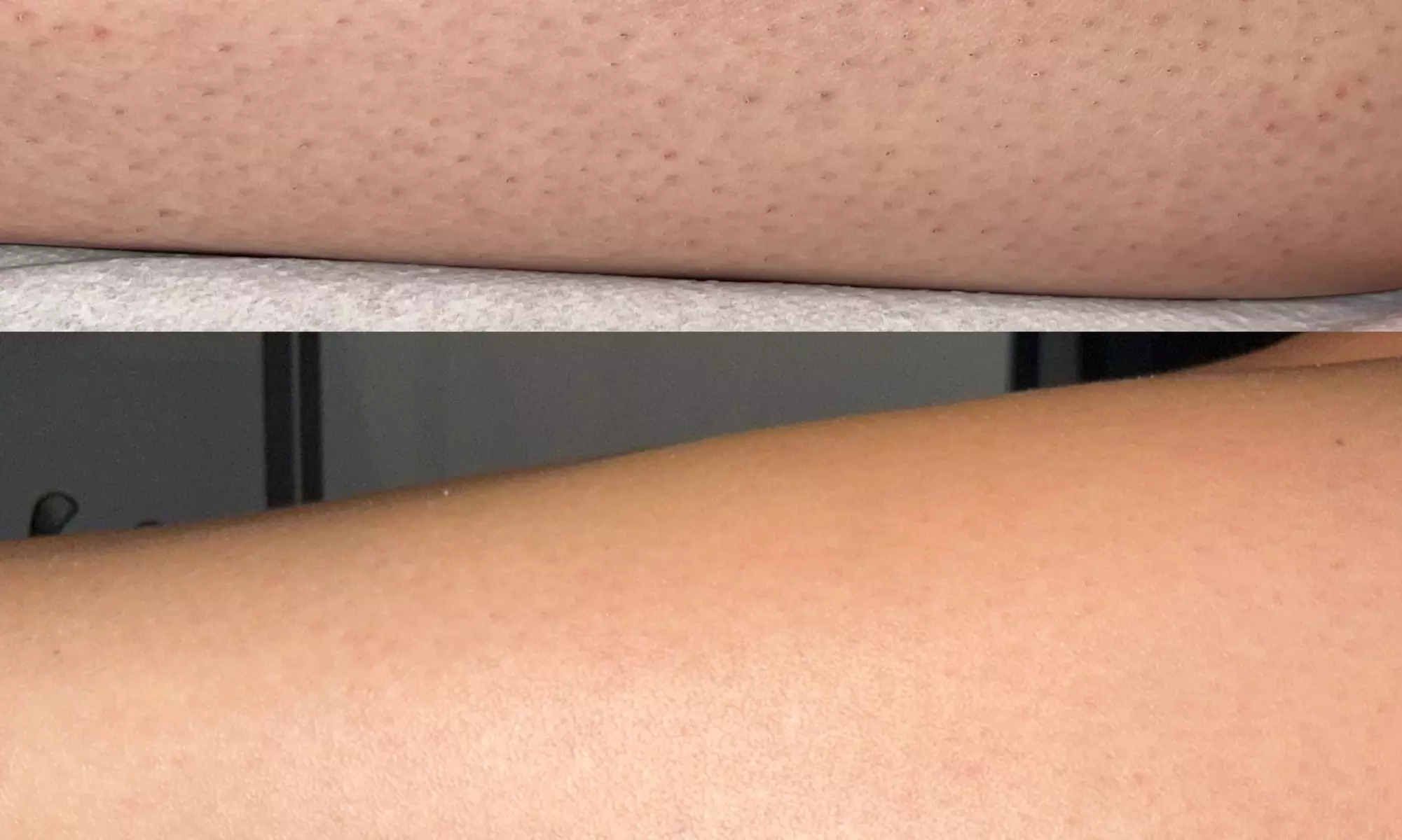 Do 50% zniżki na Depilacja laserowa w Kosmetologia estetyczna - depilacja laserowa