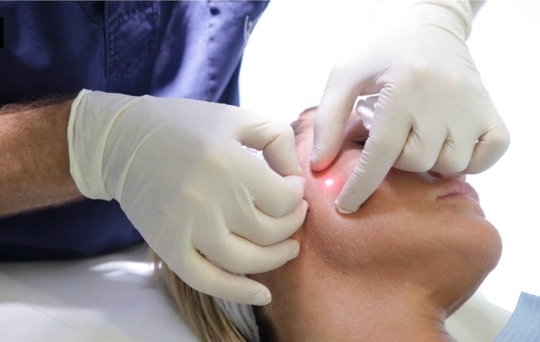 Endolaser Treatment for Underchin: Skin Tightening, Fat Reduction