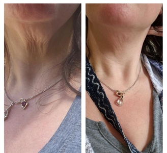 HIFU Face and Neck - My choice aesthetics