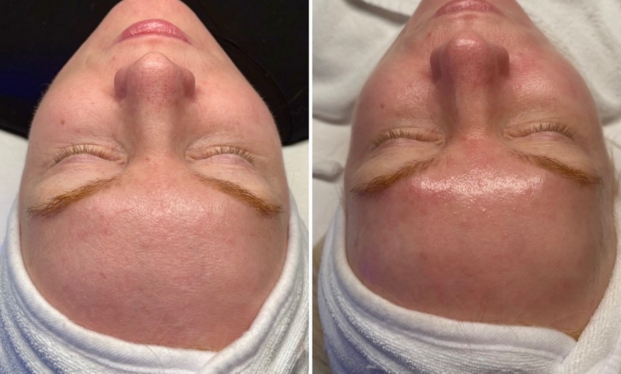 Image 5: One, Two, or Three 30-Minute Signature Hydrafacial Session for One