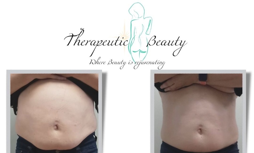 Image 2: Transform Your Tummy with Three, or Six Targeted Sessions!