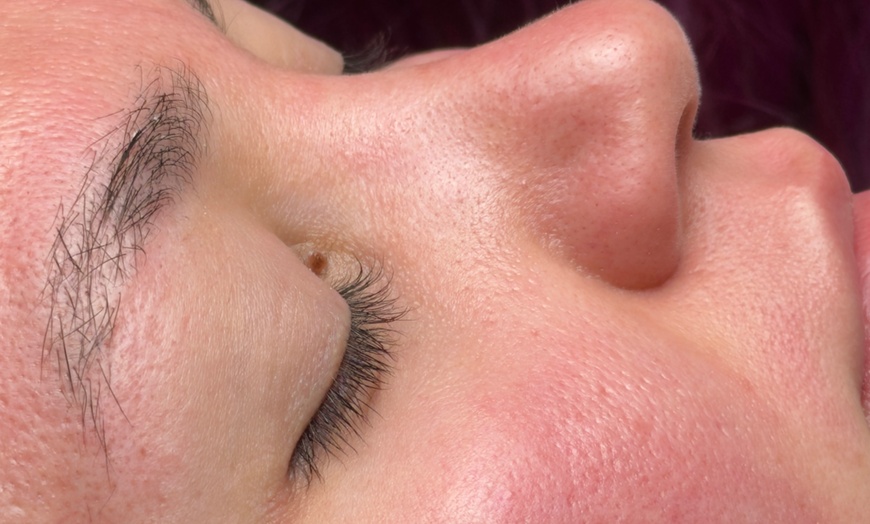 Image 2: Luxury Exosome Mesotherapy with PDRN for Skin Repair & Radiance