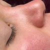 Image 2: Luxury Exosome Mesotherapy with PDRN for Skin Repair & Radiance