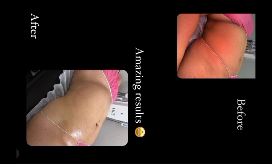 Image 2: Targeted Fat Reduction – Non-Invasive Laser Lipo Session
