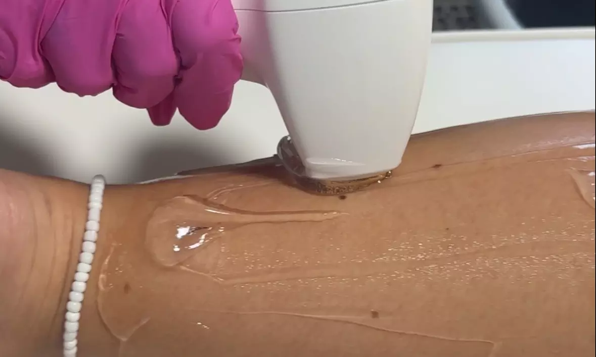 Smooth Skin w/ Six Laser Hair Removal on Small, Medium or Large Areas