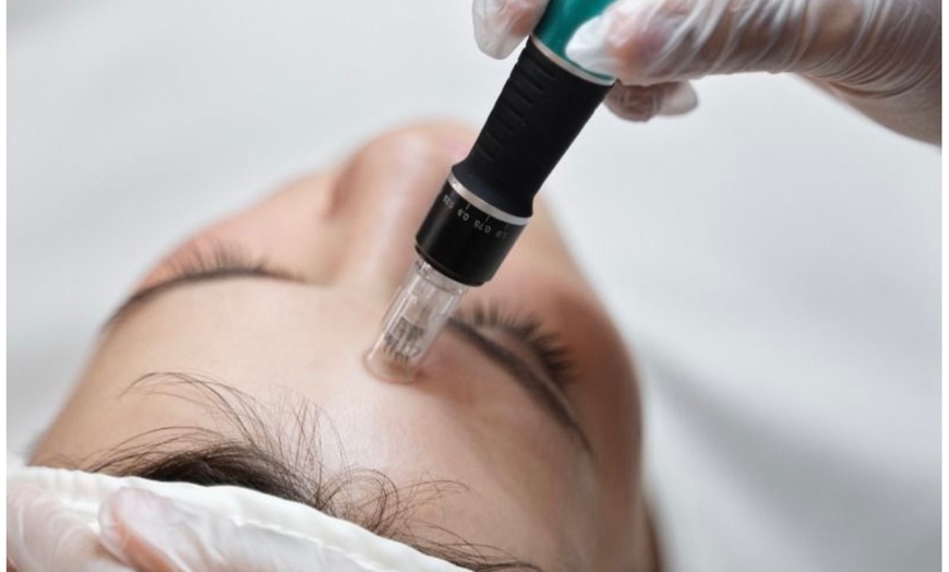 Image 3: Face and Neck Microneedling or Microneedling with Hyaluronic Acid