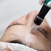 Image 3: Face and Neck Microneedling or Microneedling with Hyaluronic Acid