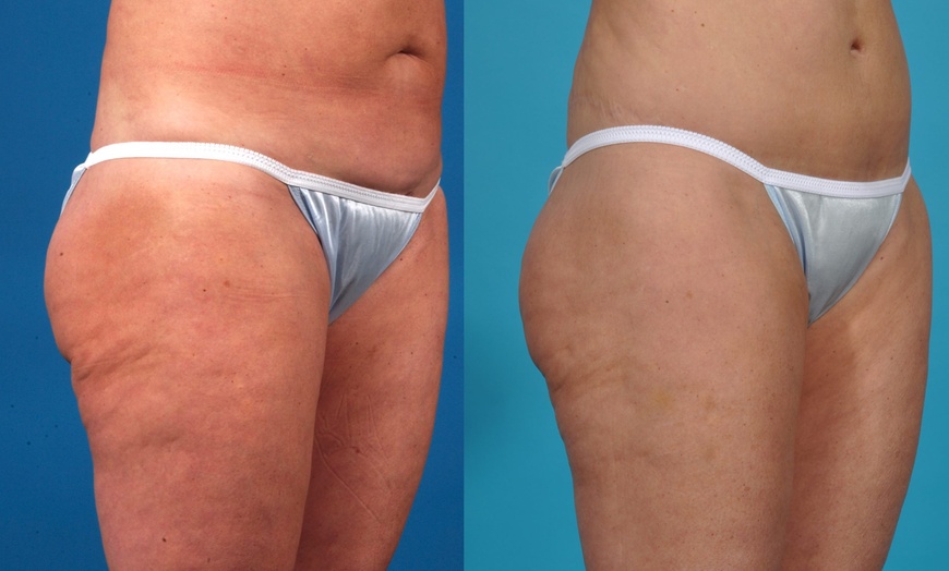 Image 8: Radiant Skin Awaits: Transform with Morpheus8 RF Technology!