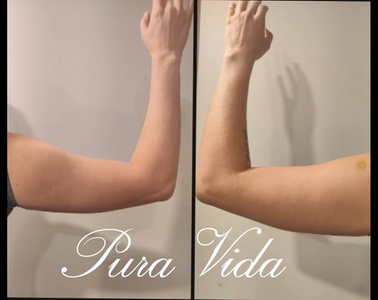 One Session - Electronic Muscle Builder and Fat Loss - Pura Vida Esthetiques LLC