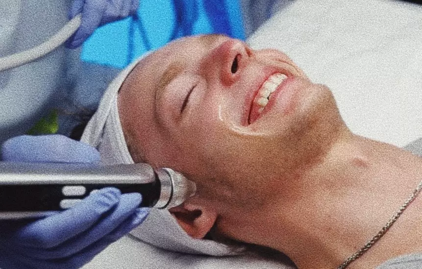 Up to 70% Off on Micro-Needling at Euro glow facial salon