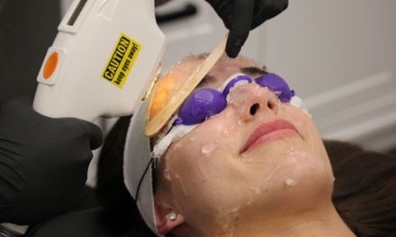 Ilp Photofacial Treatment - Peach Skin & Laser 