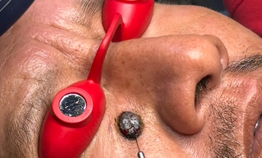 Image 3: Up to 69% Off on Injection - Plasma at Hang's Spa