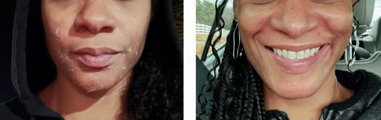 Experience The Diva Way's expert care: Two Chemical Peel Facials
