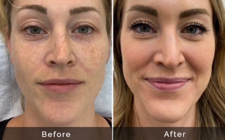 One Therma-Lift Skin-Tightening Facelift - Ckm Beauty Studios
