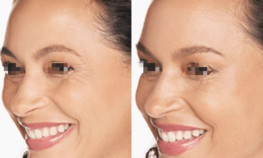 Image 5: Achieve a Smooth, Youthful Look with Xeomin: 20 Units