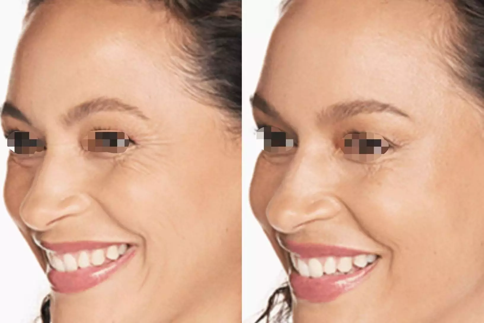 Achieve a Smooth, Youthful Look with Xeomin: 20 Units
