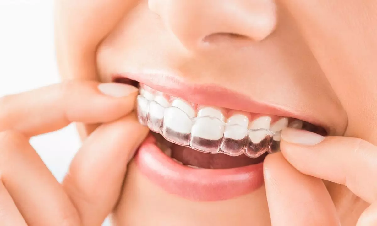 $50.00 for $2400.00 CandidPro/Invisalign at Arlington Dental  - Primary Image