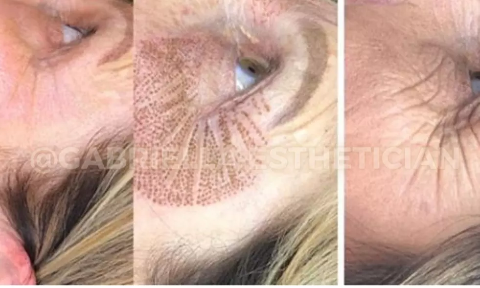 Fibroblast Plasma Pen Lifts for Face and Neck