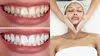 Up to 33% Off on Teeth Whitening - In-Office - Branded (Zoom, Brite Smile) at Sudden Gleam