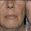 Image 7: Up to 75% Off on IPL/Photofacials at SlimmThicc Aesthetics Spa