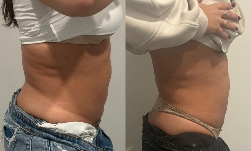 Image 6: Up to 57% Off on Ultrasonic Fat Reduction at ILLUME Skin Spa