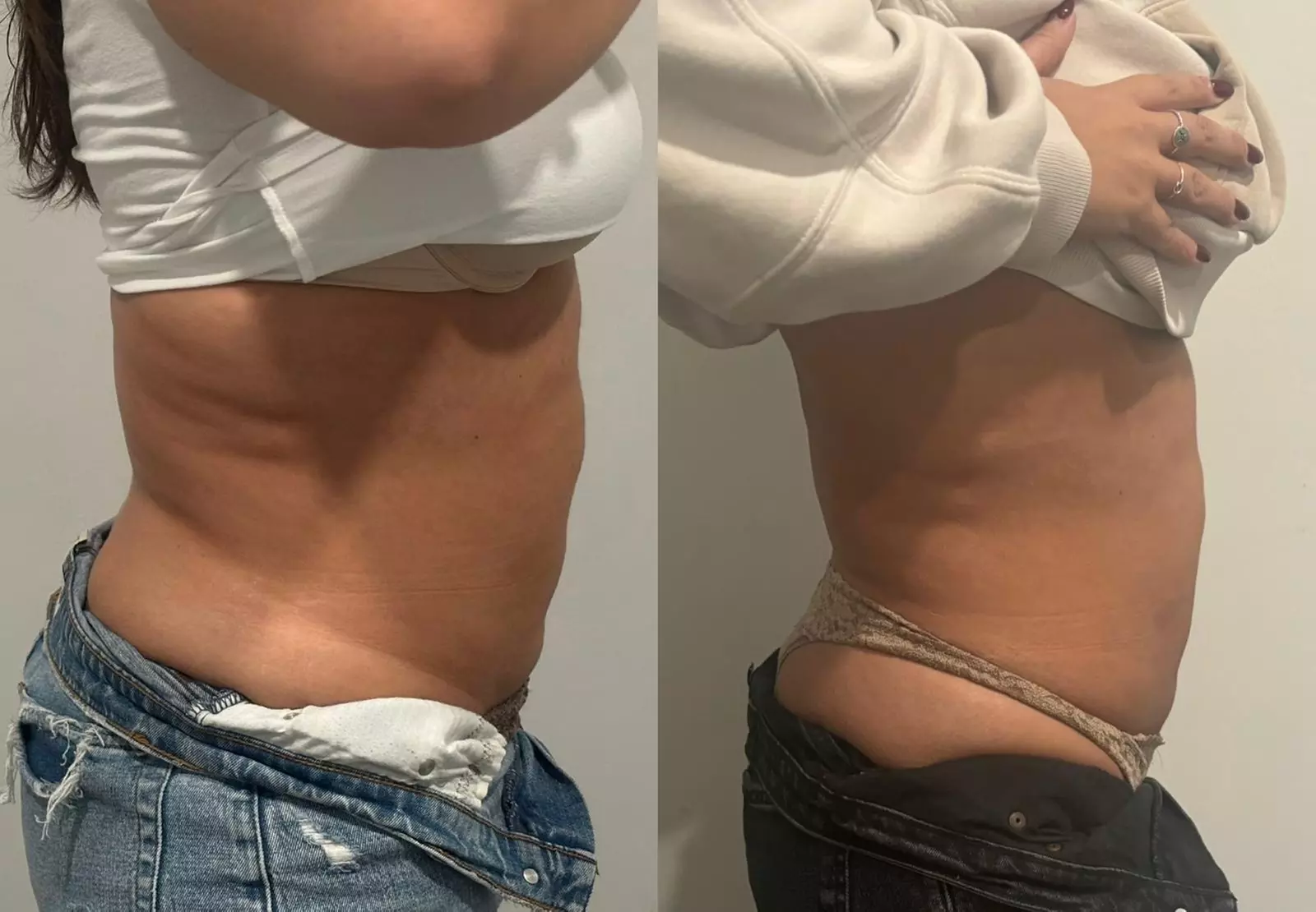 Up to 57% Off on Ultrasonic Fat Reduction at ILLUME Skin Spa