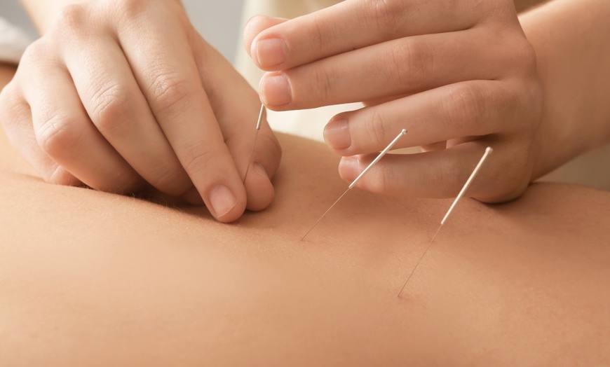 Image 2: Acupuncture Sessions for Pain Relief Stress and Wellness Care