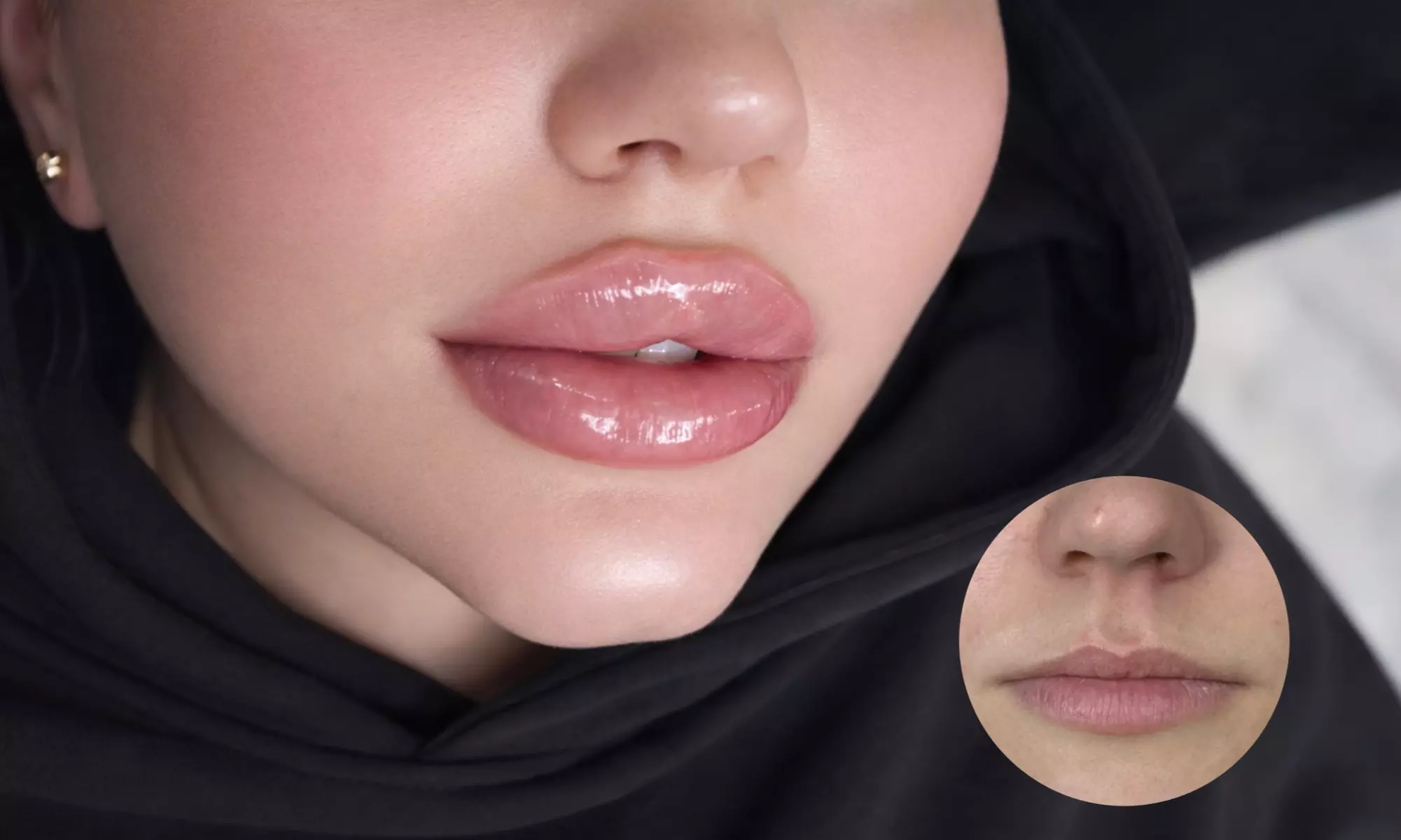 Premium Dermal Filler (REVOLAX®) - 0.5 or 1ml (Up to 57%Off)