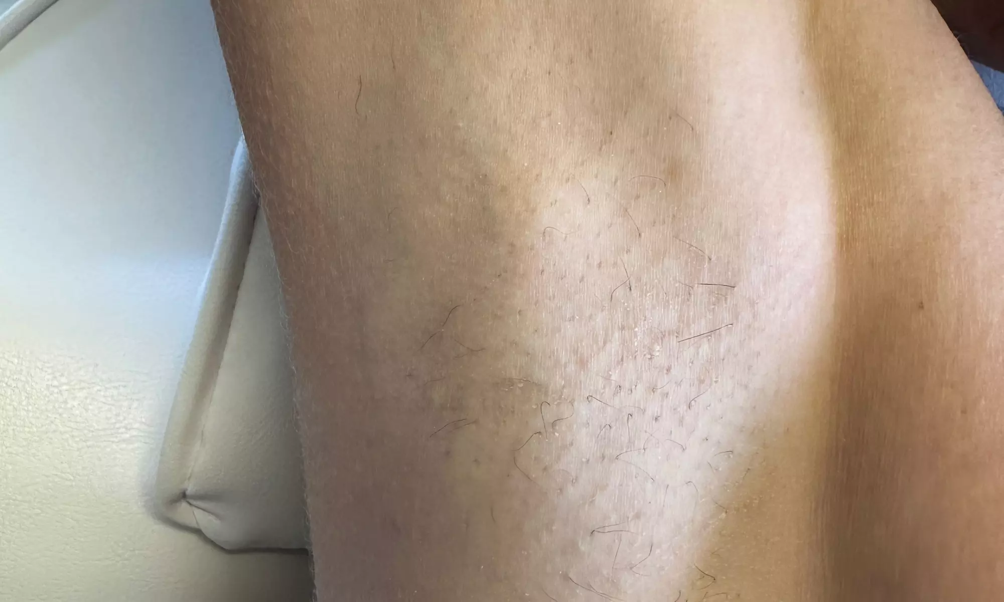 Up to 50% Off on Laser Hair Removal at Naked Lasers