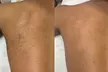 Effortless Smoothness with 3 or 6 Laser Hair-Removal Sessions on Small, Medium or Large Area (Up to 84%Off) - Second Medium