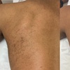Image 2: Effortless Smoothness with 3 or 6 Laser Hair-Removal Sessions on Small, Medium or Large Area (Up to 84%Off)