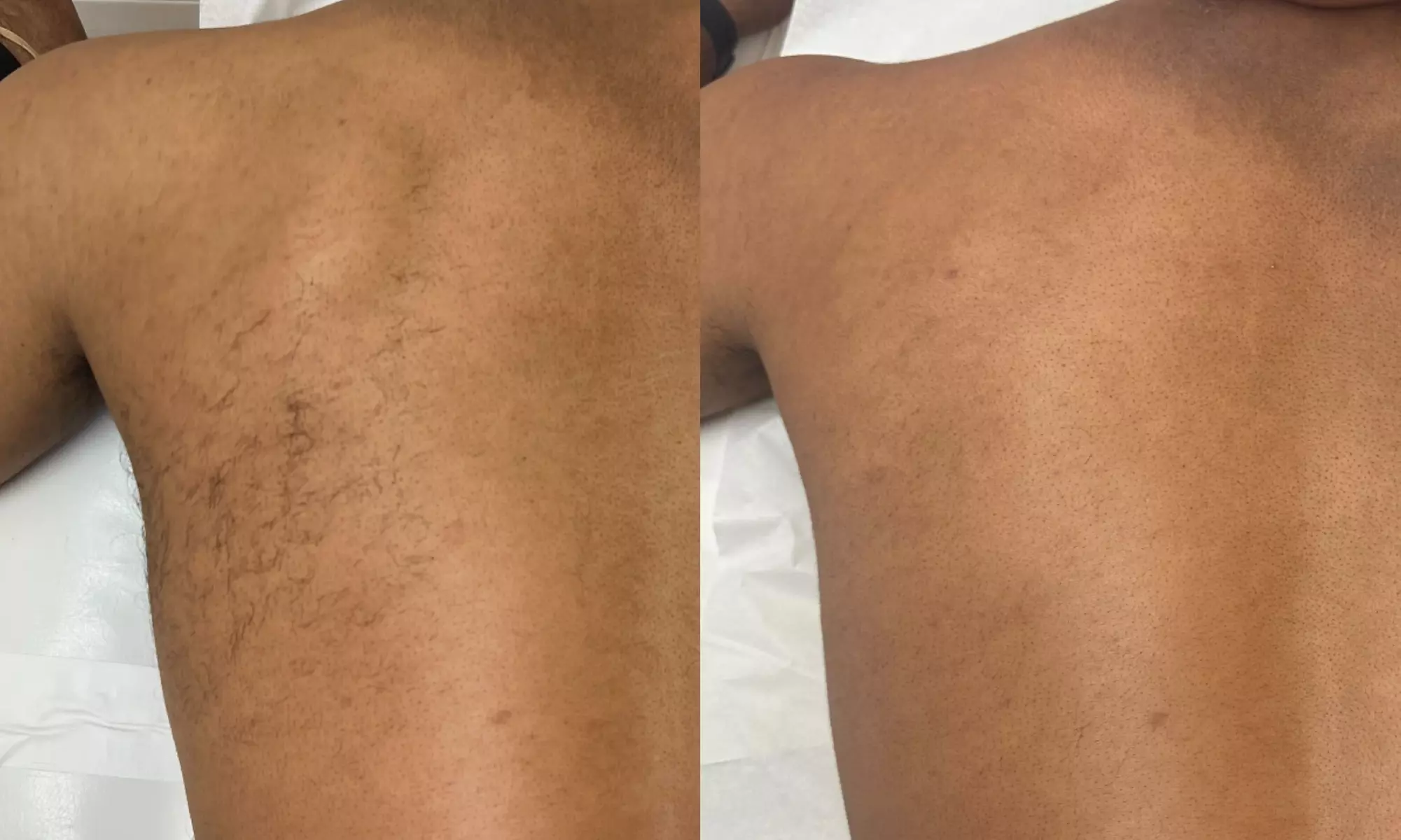 Effortless Smoothness with 3 or 6 Laser Hair-Removal Sessions on Small, Medium or Large Area (Up to 84%Off)