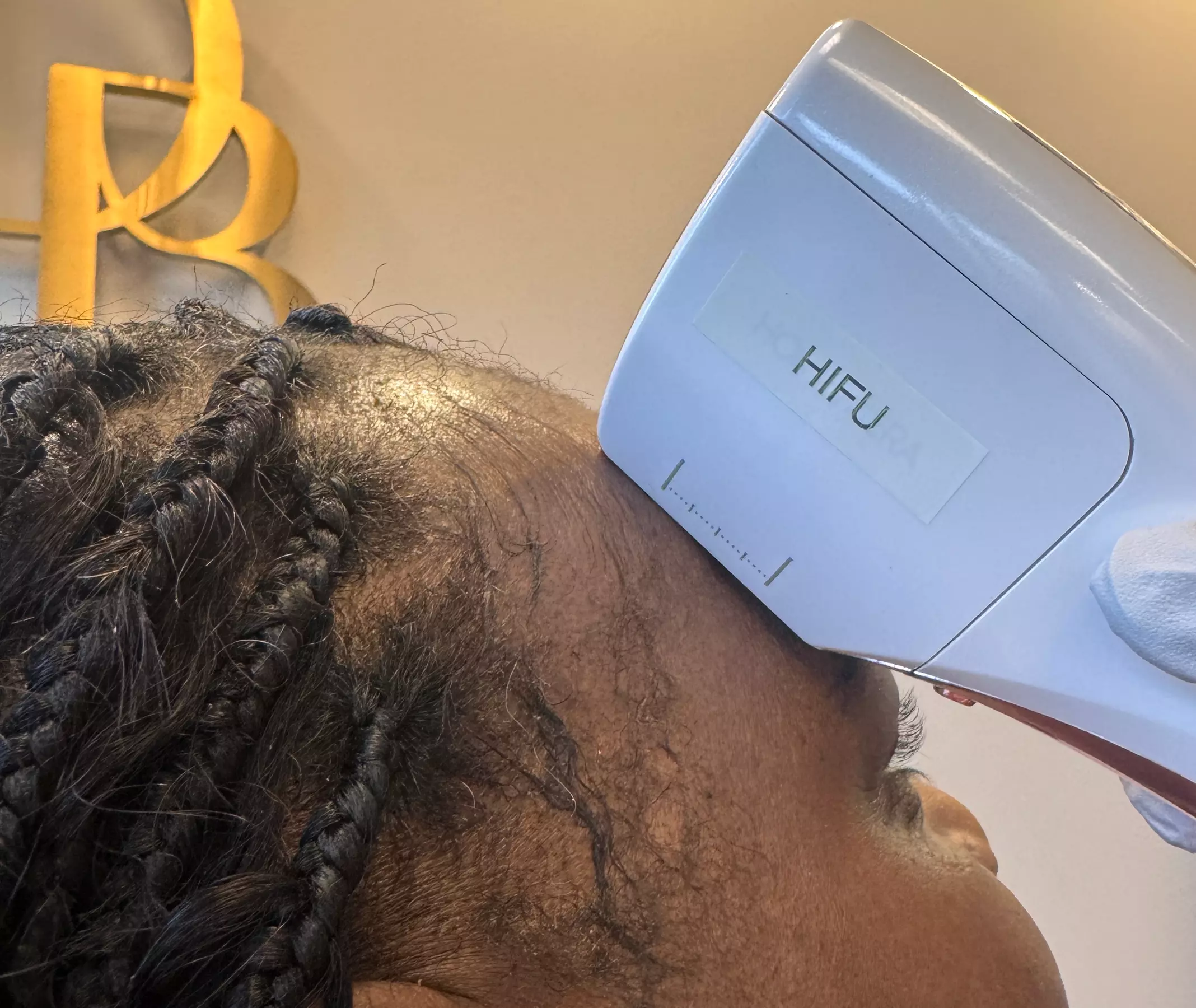 HIFU Non-Invasive Lifting, Skin Tightening of Skin, Jawline and Cheeks