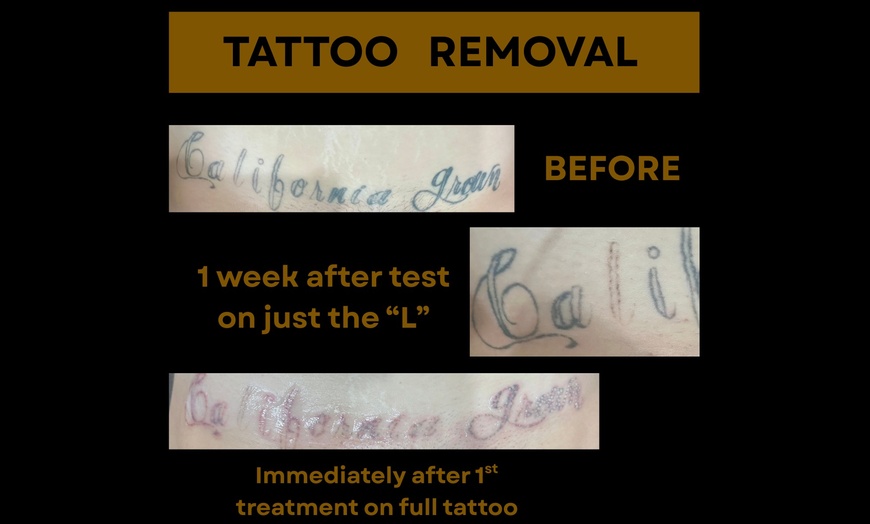 Image 4: Laser Hair Removal, Tattoo Removal, Carbon Peel, Acne Treatments
