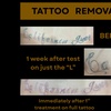 Image 4: Laser Hair Removal, Tattoo Removal, Carbon Peel, Acne Treatments