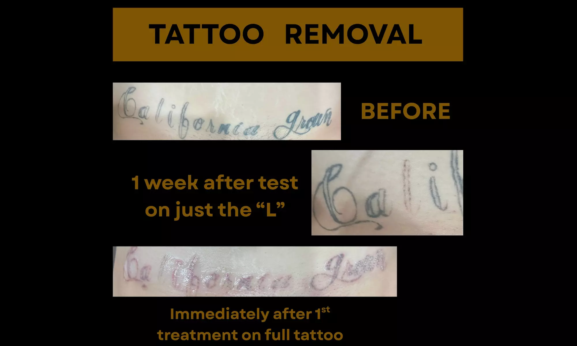 Laser Hair Removal Sessions or Laser Carbon Peel or Acne Treatments