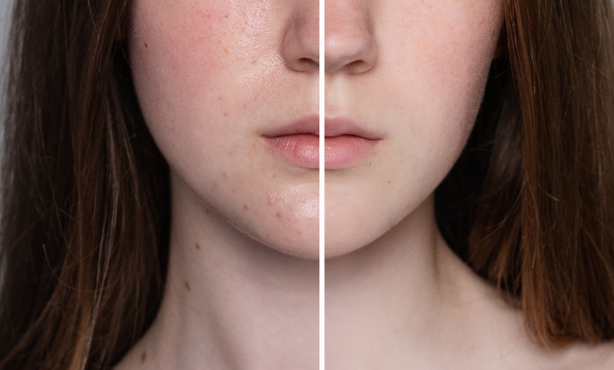 Image 10: Up to 51% Off on Acne Facial at Skin Deep Beauty and Beyond