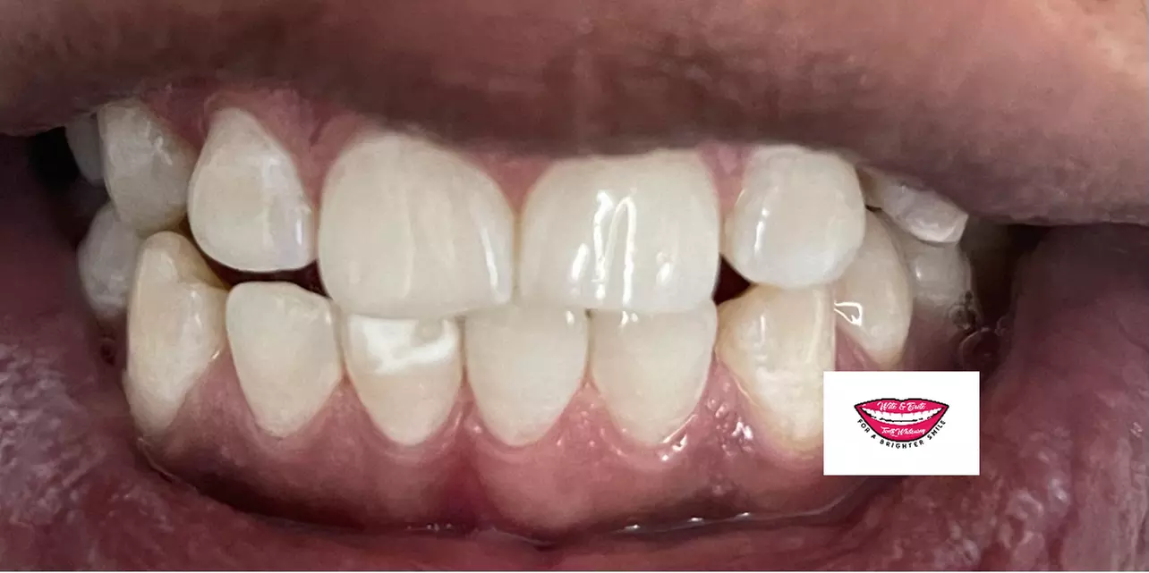Experience up to 70% off with Wite & Brite Teeth Whitening's One Hour Treatments - Primary Image