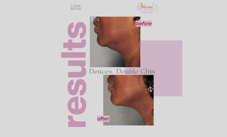 Image 3: Therma-Lift Facelifts for Youthful Skin with No Downtime